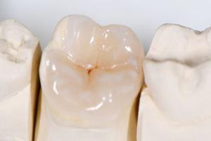 zubni-polokorunky-01-300x200