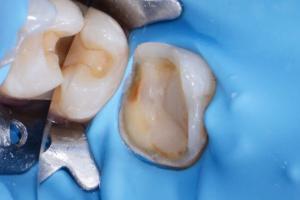 zubni-polokorunky-03-300x200