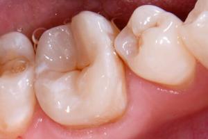 zubni-polokorunky-04-300x200