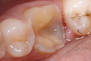 zubni-polokorunky-05-300x200