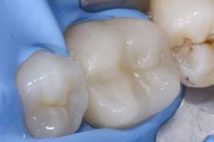 zubni-polokorunky-06-300x200