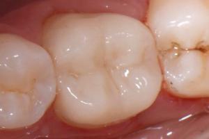 zubni-polokorunky-07-300x200